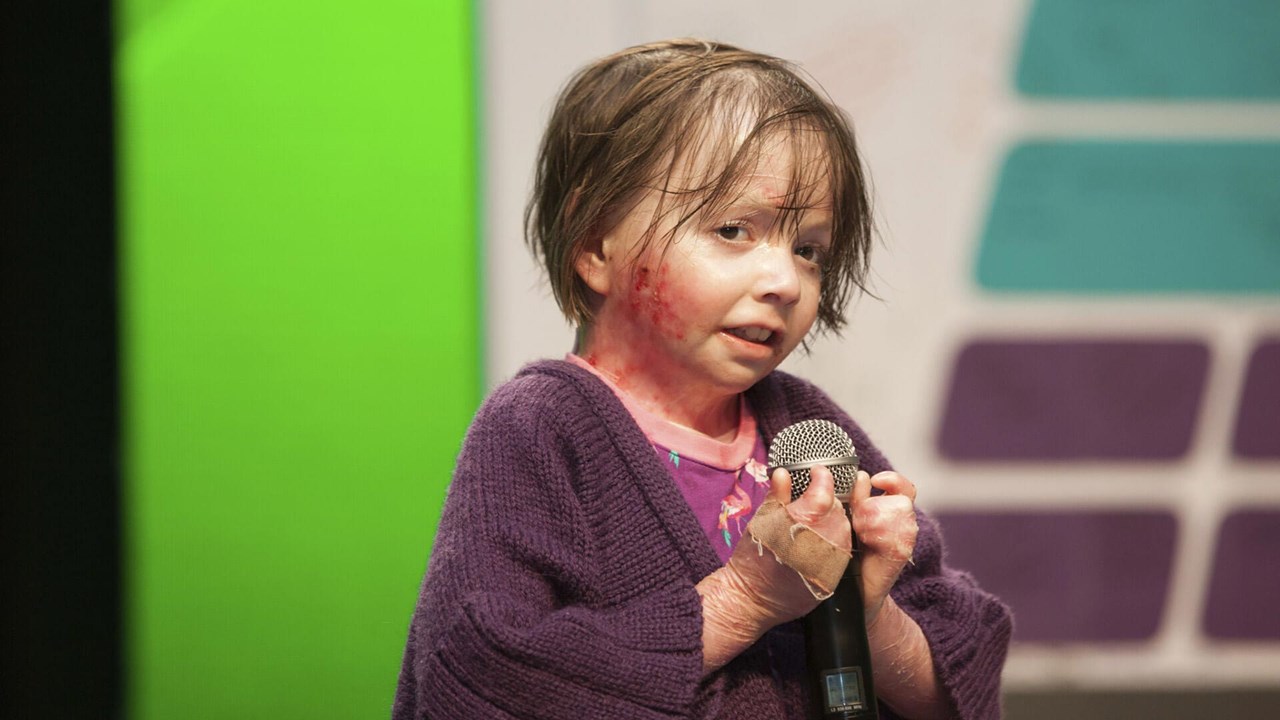 a little girl affected by epidermolysis bullosa (EB)